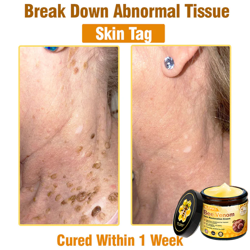 🍀TLOPA® Bee Venom Skin Restoration Cream –💖 Anti-aging,Hydrating, Skin Repair, Even Tone, Acne and Dark Spot Treatment, Wart and Mole Removal, Psoriasis Relief