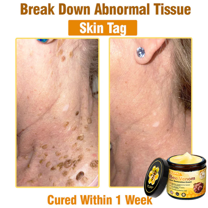 🍀TLOPA® Bee Venom Skin Restoration Cream –💖 Anti-aging,Hydrating, Skin Repair, Even Tone, Acne and Dark Spot Treatment, Wart and Mole Removal, Psoriasis Relief