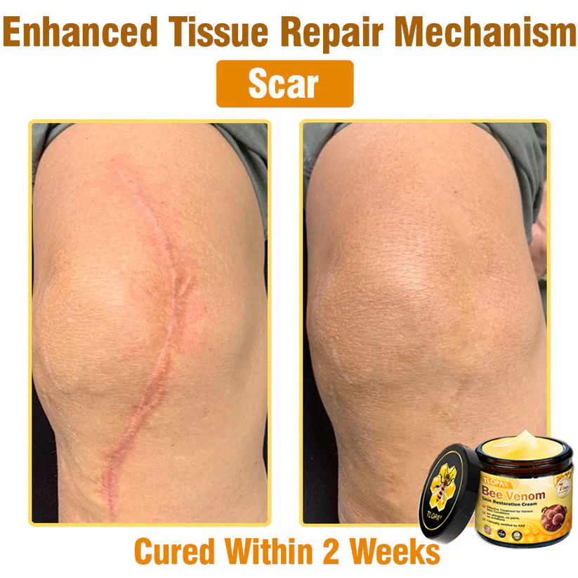 🍀TLOPA® Bee Venom Skin Restoration Cream –💖 Anti-aging,Hydrating, Skin Repair, Even Tone, Acne and Dark Spot Treatment, Wart and Mole Removal, Psoriasis Relief