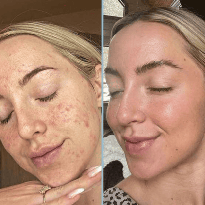 Final 3 Hours 70% OFF🔥 Gentle Exfoliator Glow Rice Ampoule-Suitable for All Skin Types